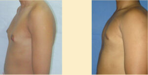 gynecomastia Treatment before after