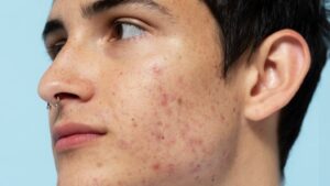 acne treatment