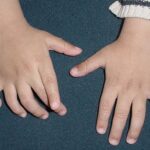 Congenital Hand Deformities