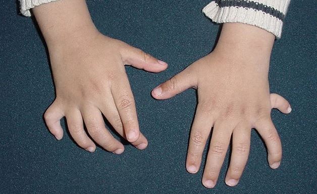Congenital Hand Deformities