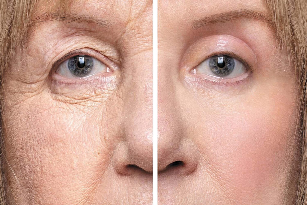 Blepharoplasty Surgery