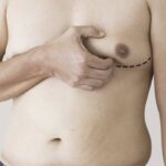 Gynecomastia Treatment