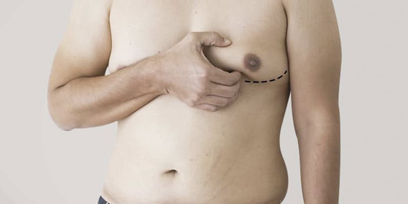 Gynecomastia Treatment