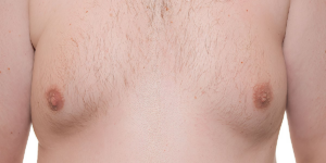 Top Gynecomastia Surgeon in Thane