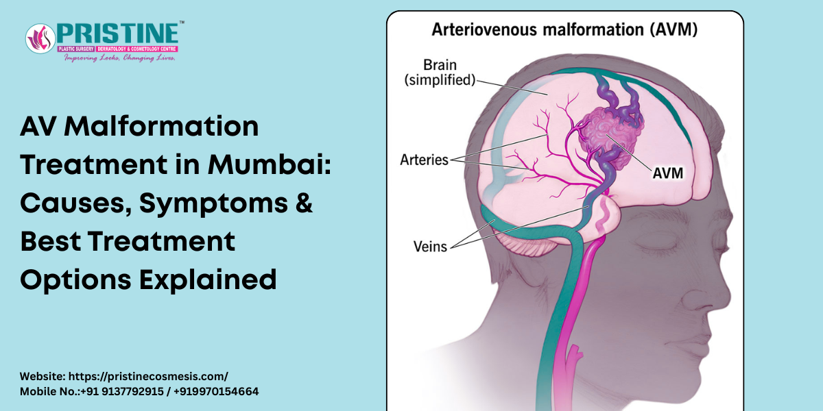 AV Malformation Treatment in Mumbai