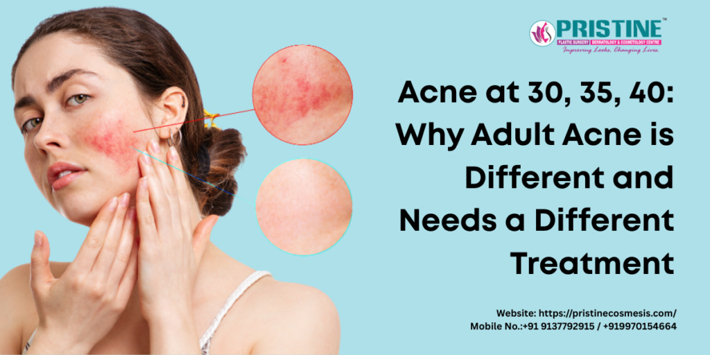 Acne at 30, 35, 40: Why Adult Acne is Different and Needs a Different Treatment