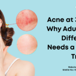 Acne at 30, 35, 40: Why Adult Acne is Different and Needs a Different Treatment