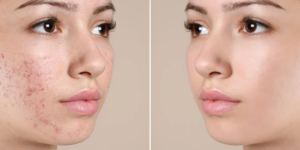 Adult Acne Treatment in Thane