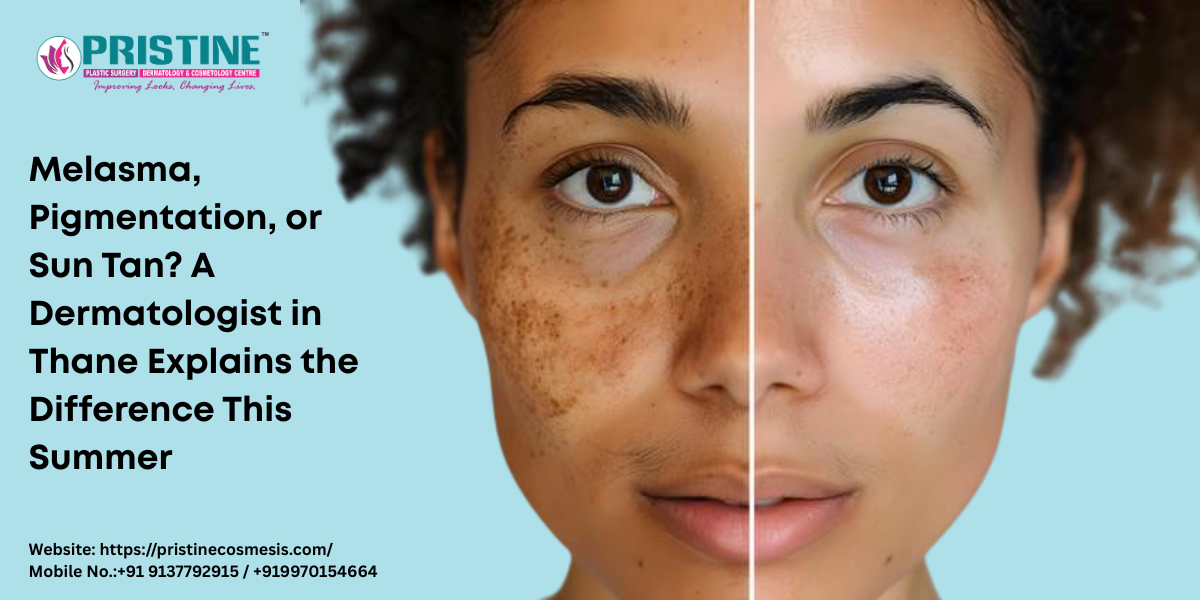 Melasma, Pigmentation or Sun Tan? Dermatologist in Thane Explains