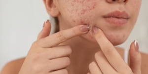 Acne Scar Treatment in Thane: Latest Laser & Collagen Boosting Solutions for Clear Skin in 2026