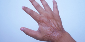 Skin Grafting in Thane