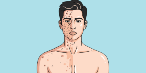 Skin Brightening treatment in Thane